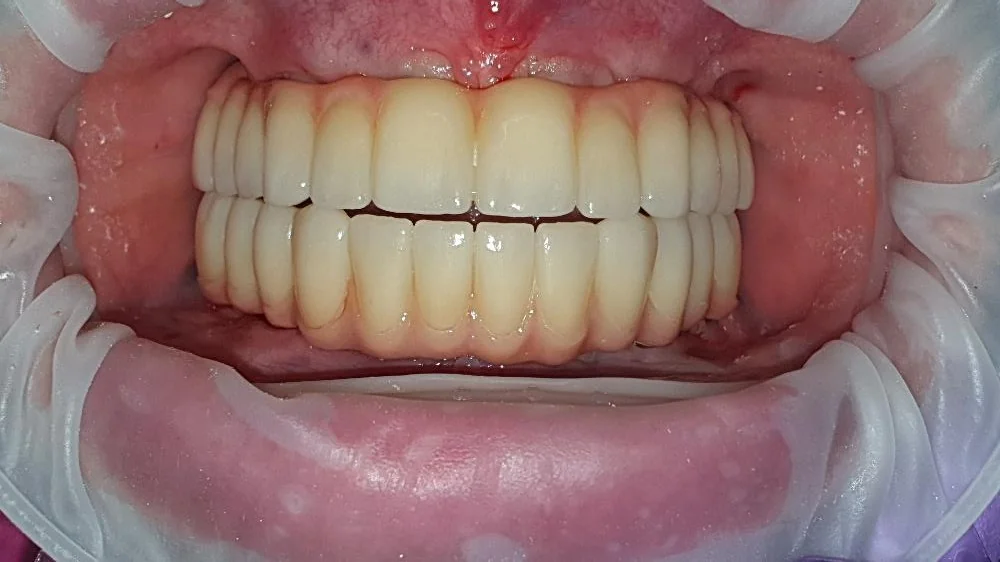 Rezultat clinic real al unei reabilitări complete a arcadei pe implanturi All-on-6 finalizate la Denti Service Bacău