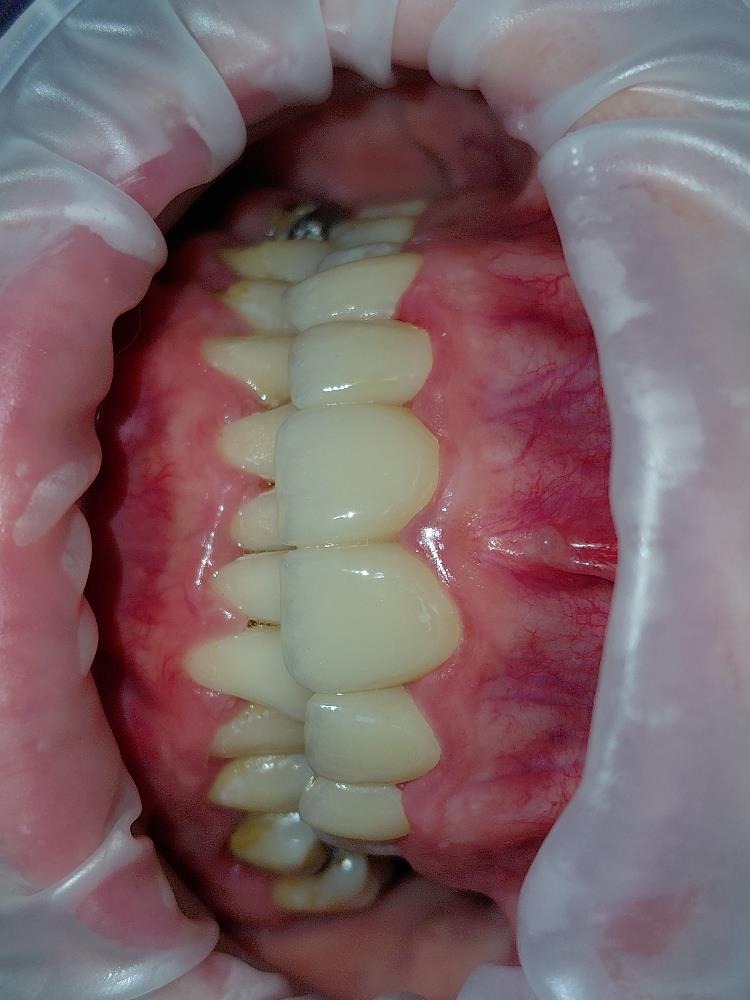 După — Reabilitare orală complexă