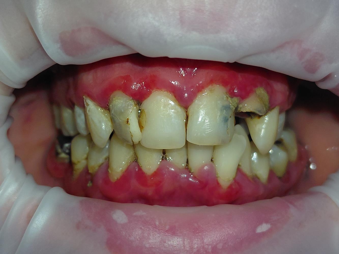 Înainte — Reabilitare orală complexă