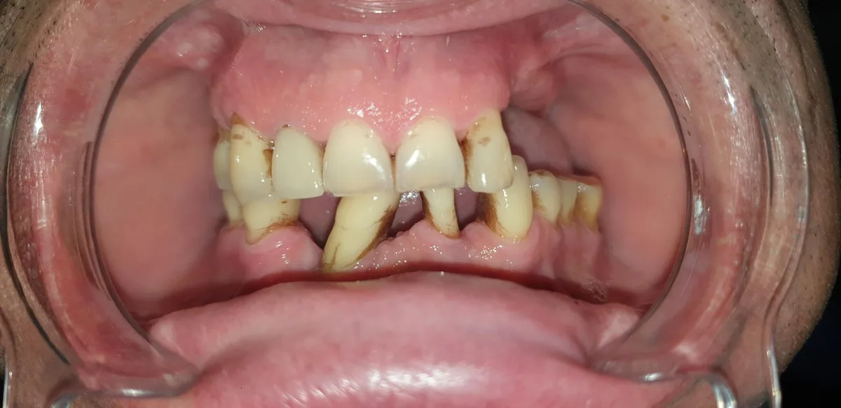 Imagine clinică intraorală — semne vizibile de afectare parodontală: recesiune gingivală, tartru și inflamație la marginea gingivală