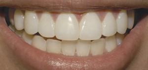 Coroană dentară din zirconiu