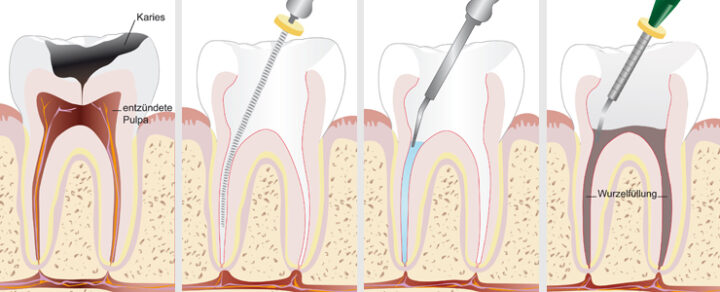 Endodonţie