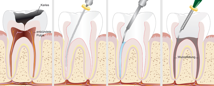 Endodonţie