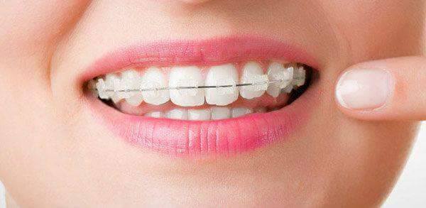 Ortodonţie – aparat Safir