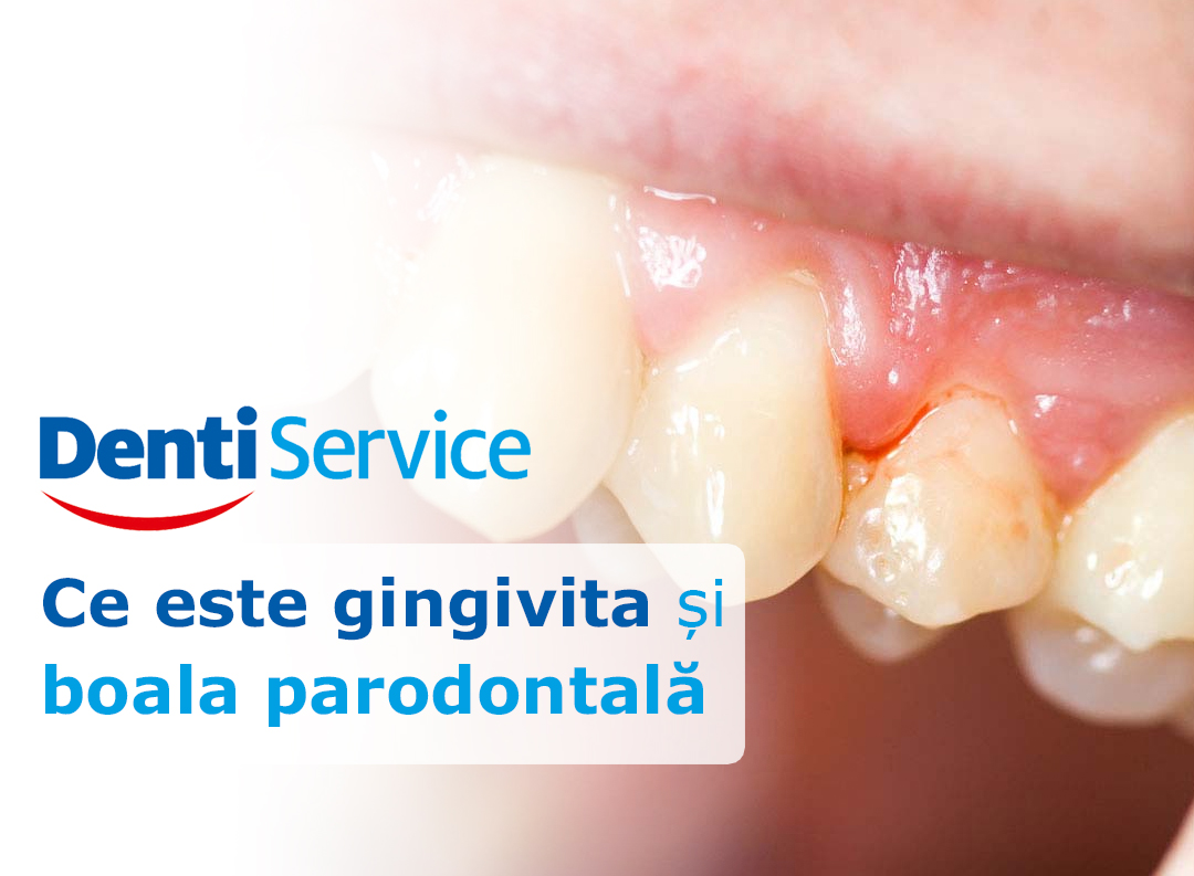 Ce este gingivita și boala parodontală 