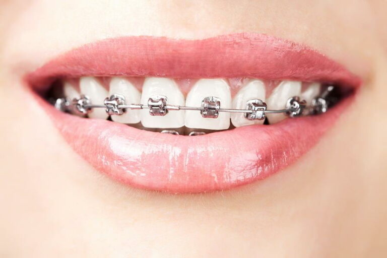 Beneficiile oferite de tratamentul ortodontic