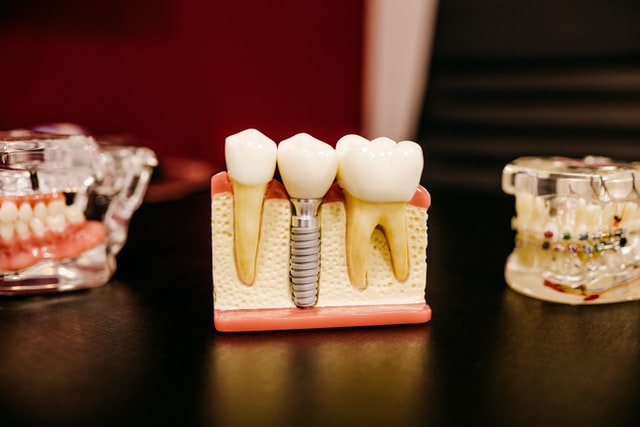 Știai că implanturile dentare sunt înconjurate de foarte multe mituri?
