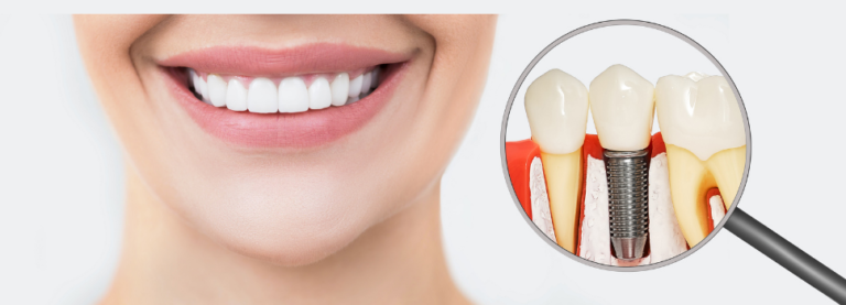De ce implantul dentar este o alegere pentru înlocuirea dinților lipsă?