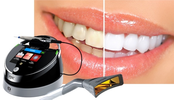 Albire laser Biolase